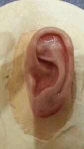 بديل زراعة صيوان الاذن جراحيا هو الاذن الصناعية التي تماثل شكل أذن المريض و لون بشرته الحقيقي