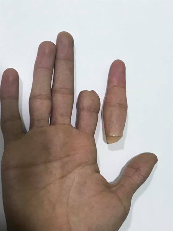 قطع الإصبع وعلاجه بعد فشل اعادة توصيل الاصبع الطبيعي